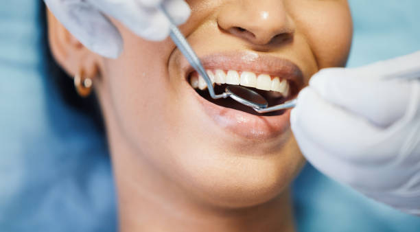 Best Knocked-Out Tooth (Avulsed Tooth) Treatment in Pueblo West, CO